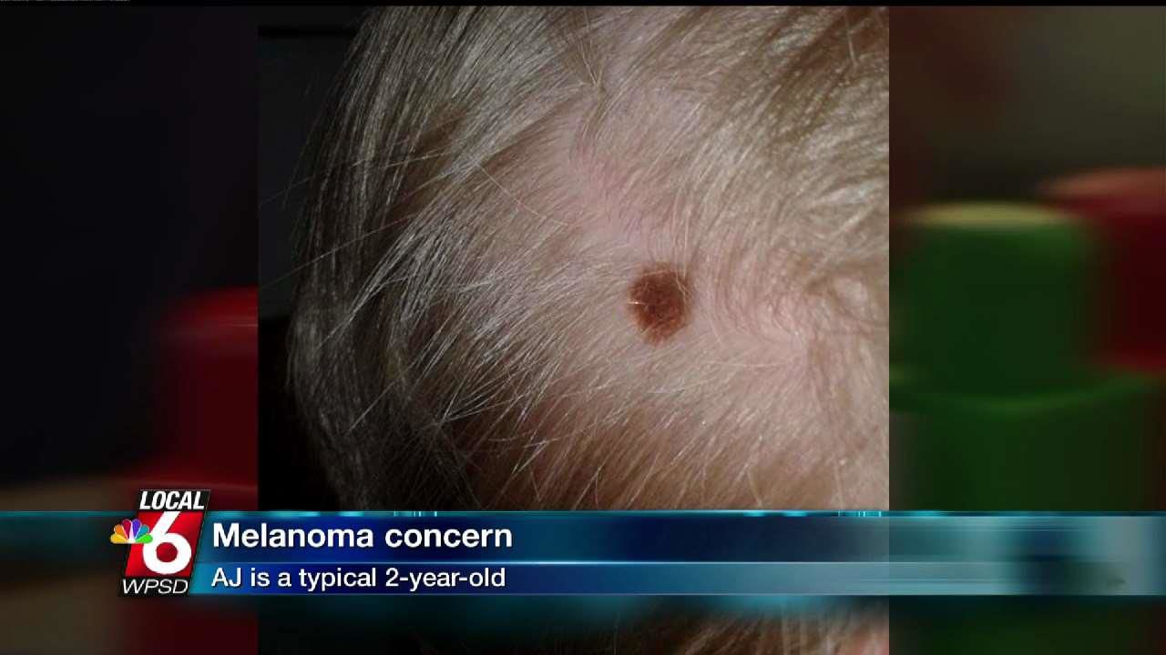Melanoma-Special-Report-image